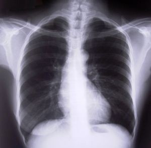 262068_chest_xray-300x294