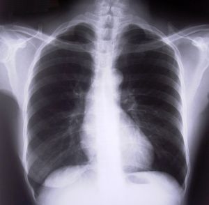 262068_chest_xray.jpg